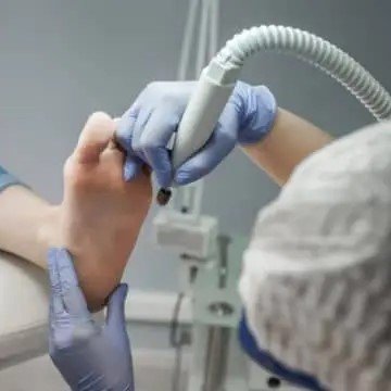 Tratamento Podológico de Calosidade com Tecnologia